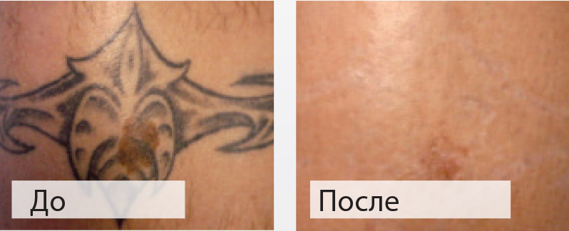 Удаление чёрной татуировки в клинике лазерной косметологии «Bella-Skin Clinic»