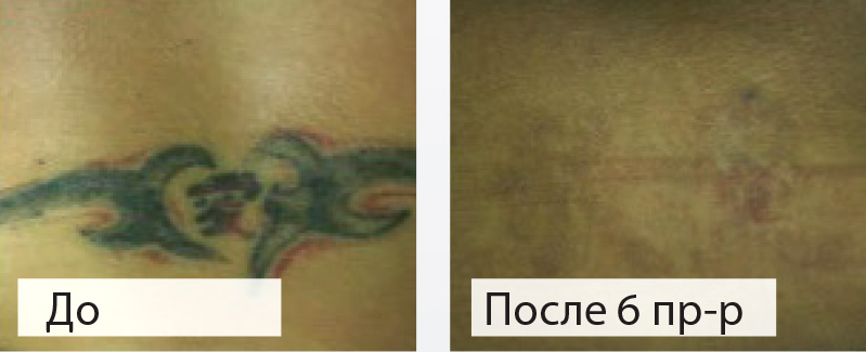 Удаление цветных татуировок в «Bella-Skin Clinic»
