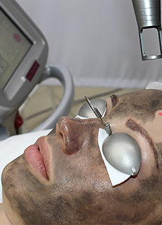 Карбоновый пилинг Spectra Peel в клинике лазерной косметологии «Bella-Skin Clinic»